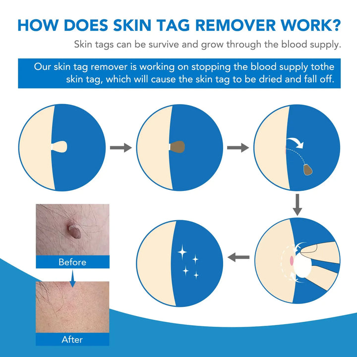Home Skin Tag Removal Kit