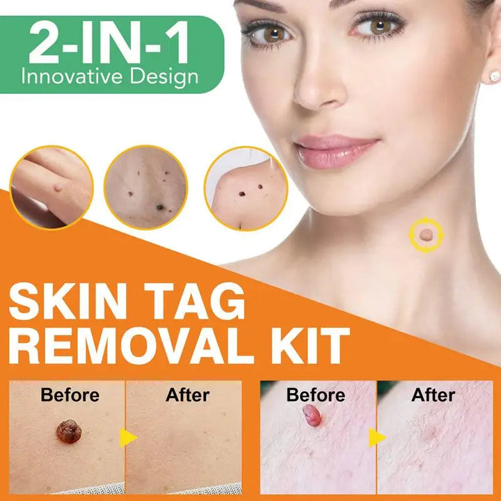 Home Skin Tag Removal Kit